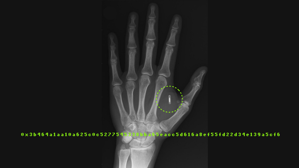 An X-ray showing a microchip implanted in a person's hand, superimposed with an alphanumeric code in green